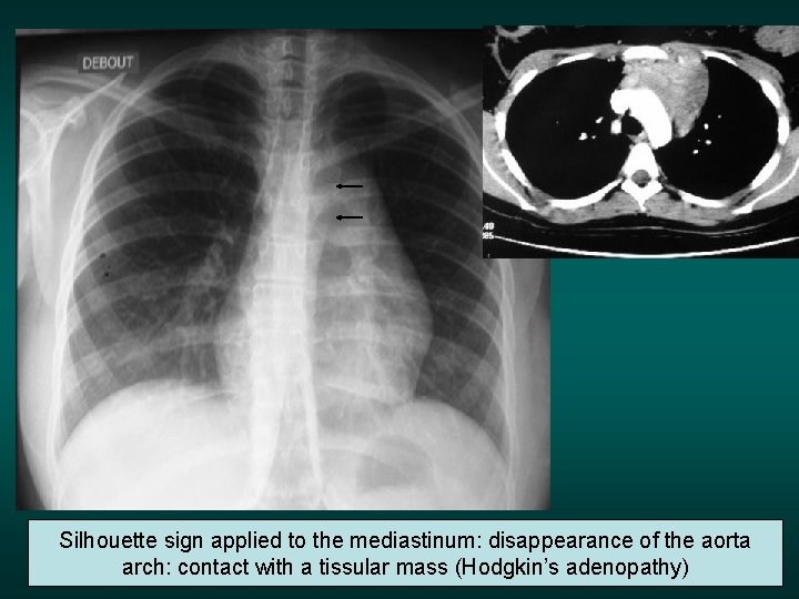Silhouette sign applied to the mediastinum: disappearance of the aorta arch: contact with a
