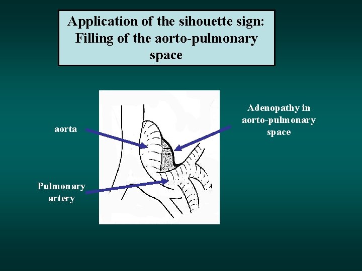 Application of the sihouette sign: Filling of the aorto-pulmonary space aorta Pulmonary artery Adenopathy