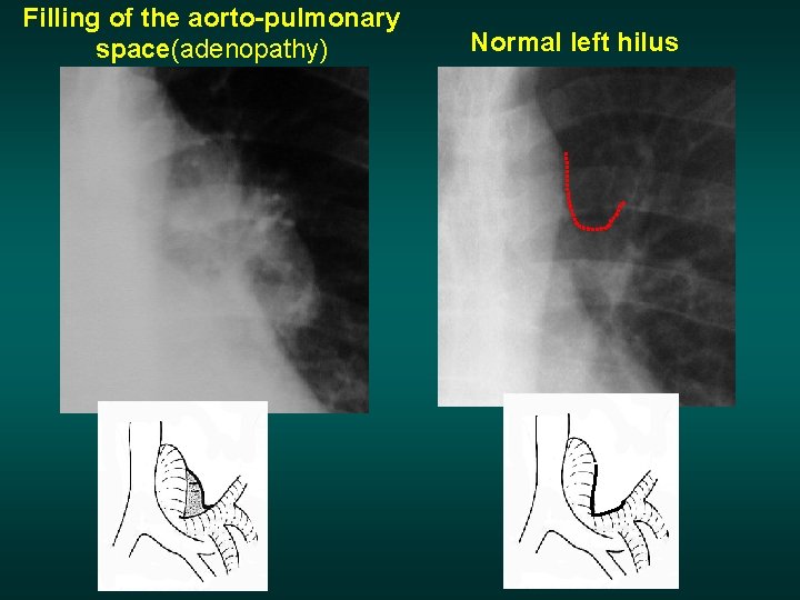 Filling of the aorto-pulmonary space(adenopathy) Normal left hilus 