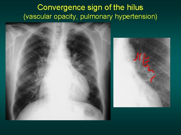 Convergence sign of the hilus (vascular opacity, pulmonary hypertension) 