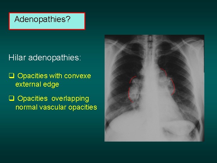 Adenopathies? Hilar adenopathies: q Opacities with convexe external edge q Opacities overlapping normal vascular