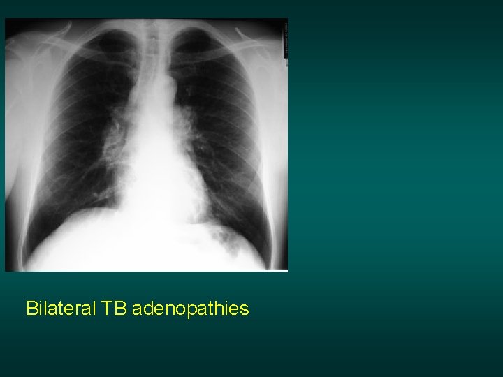 Bilateral TB adenopathies 