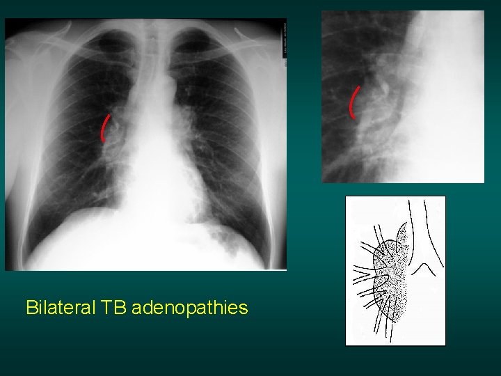 Bilateral TB adenopathies 