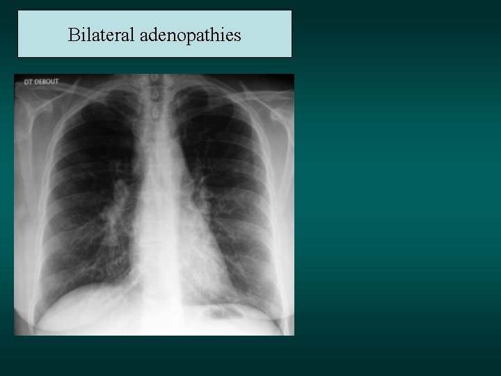 Bilateral adenopathies 