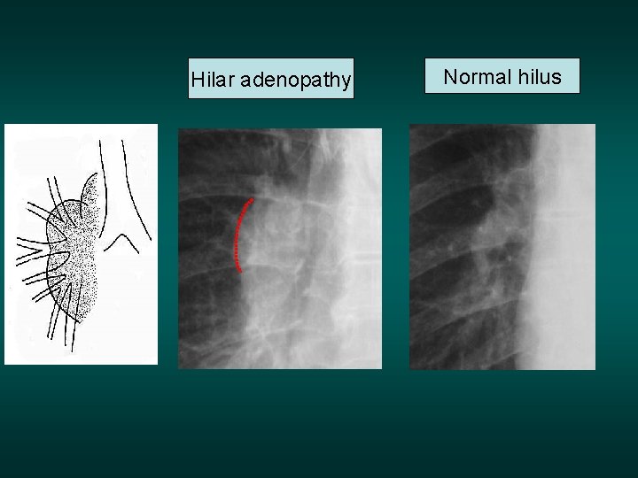 Hilar adenopathy Normal hilus 