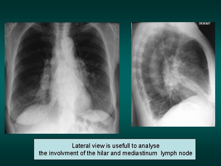 Lateral view is usefull to analyse the involvment of the hilar and mediastinum lymph