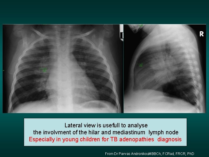 Lateral view is usefull to analyse the involvment of the hilar and mediastinum lymph