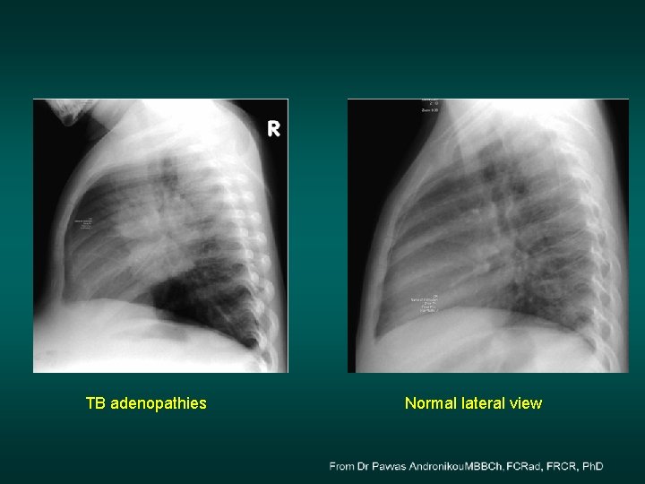 TB adenopathies Normal lateral view 