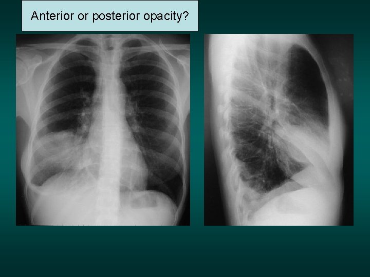 Anterior or posterior opacity? 