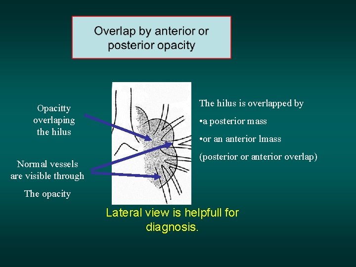 Opacitty overlaping the hilus Normal vessels are visible through The hilus is overlapped by