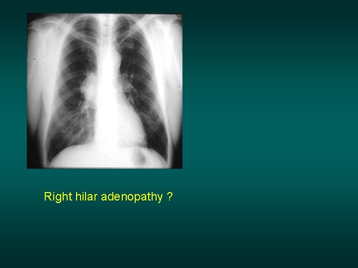 Right hilar adenopathy ? 