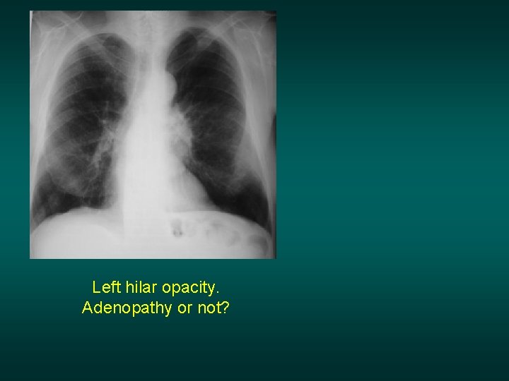 Left hilar opacity. Adenopathy or not? 