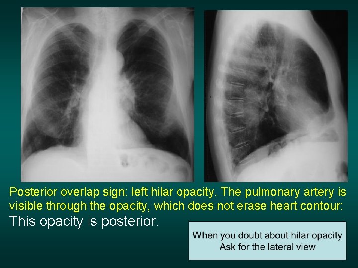 Posterior overlap sign: left hilar opacity. The pulmonary artery is visible through the opacity,