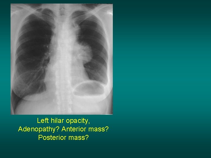 Left hilar opacity, Adenopathy? Anterior mass? Posterior mass? 