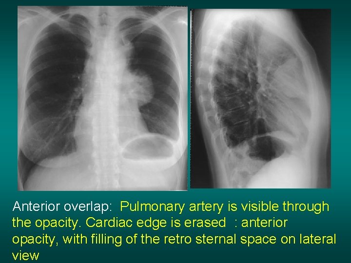 Anterior overlap: Pulmonary artery is visible through the opacity. Cardiac edge is erased :