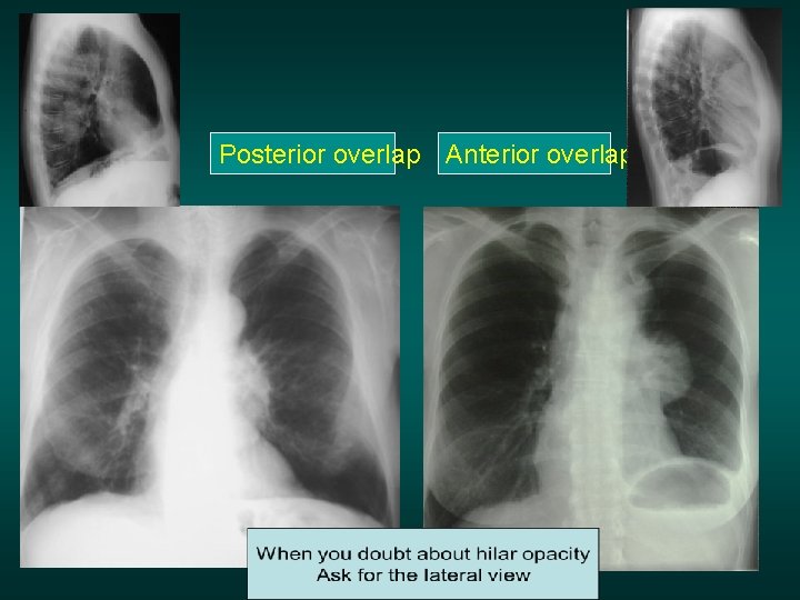 Posterior overlap Anterior overlap 