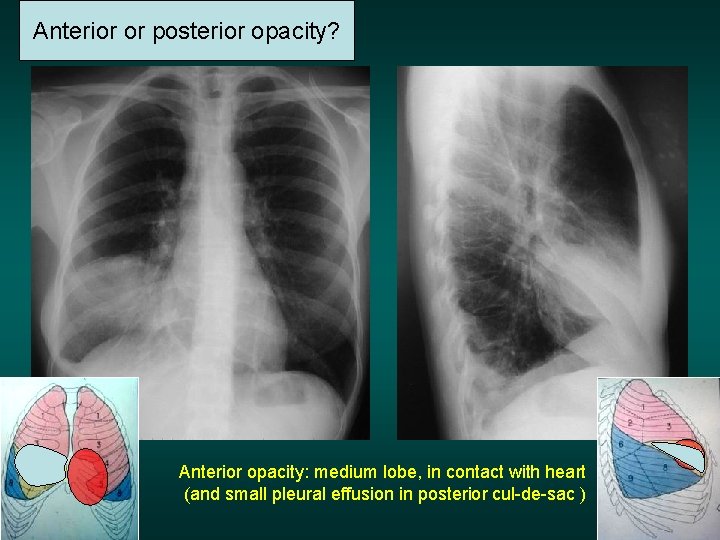 Anteriorororposterioropacity? Anterior opacity: medium lobe, in contact with heart (and small pleural effusion in