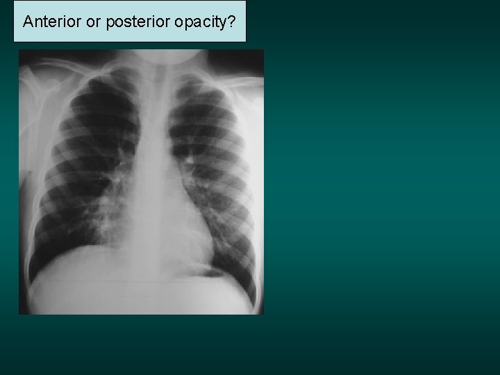 Anterior or posterior opacity? 