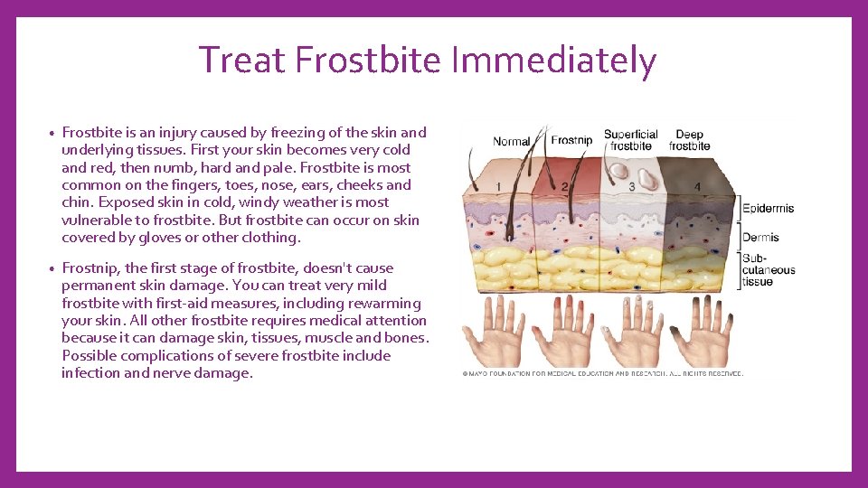 Treat Frostbite Immediately • Frostbite is an injury caused by freezing of the skin