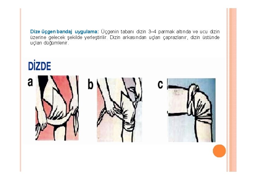 Dize üçgen bandaj uygulama: Üçgenin tabanı dizin 3– 4 parmak altında ve ucu dizin