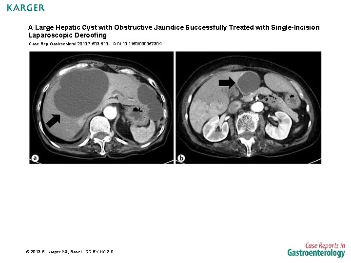 A Large Hepatic Cyst with Obstructive Jaundice Successfully Treated with Single-Incision Laparoscopic Deroofing Case