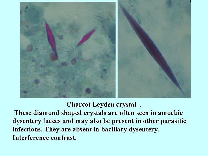 Charcot Leyden crystal. These diamond shaped crystals are often seen in amoebic dysentery faeces