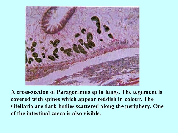 A cross-section of Paragonimus sp in lungs. The tegument is covered with spines which