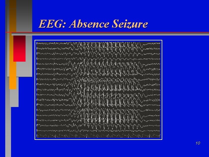 EEG: Absence Seizure 10 