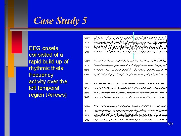 Case Study 5 EEG onsets consisted of a rapid build up of rhythmic theta