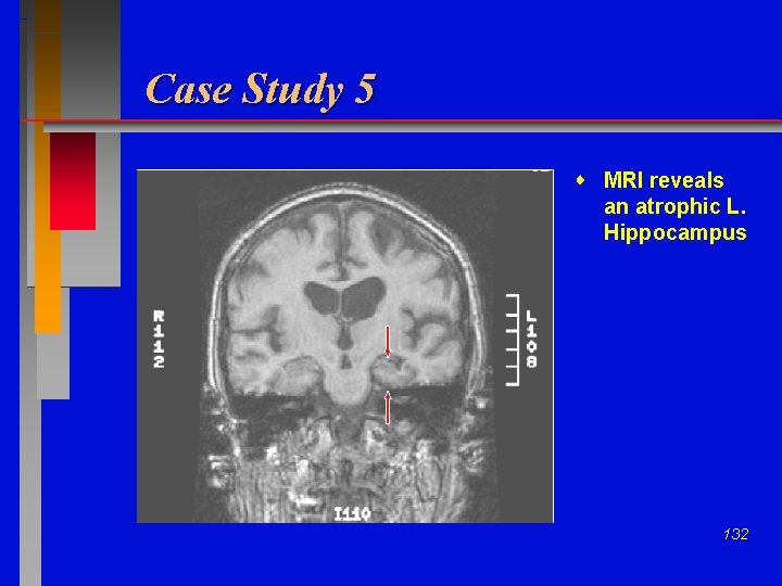 Case Study 5 MRI reveals an atrophic L. Hippocampus 132 