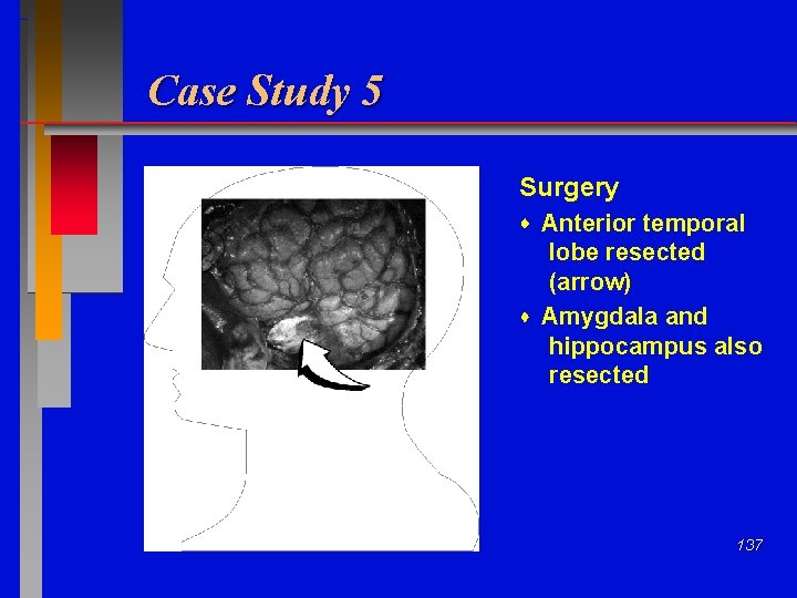 Case Study 5 Surgery Anterior temporal lobe resected (arrow) Amygdala and hippocampus also resected