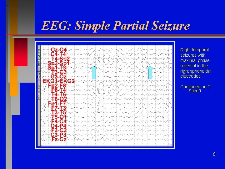 EEG: Simple Partial Seizure Right temporal seizures with maximal phase reversal in the right