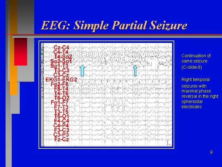 EEG: Simple Partial Seizure Continuation of same seizure (C-slide-8) Right temporal seizures with maximal