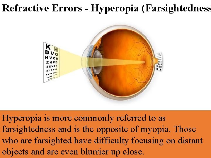 Refractive Errors - Hyperopia (Farsightedness Hyperopia is more commonly referred to as farsightedness and