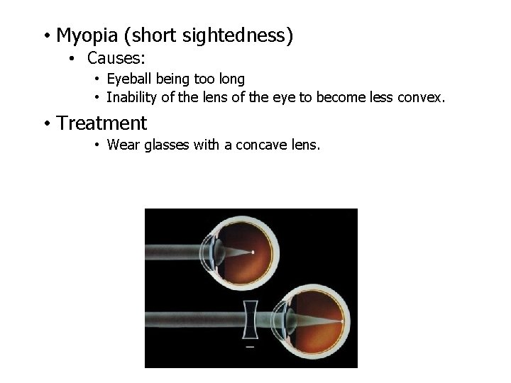  • Myopia (short sightedness) • Causes: • Eyeball being too long • Inability