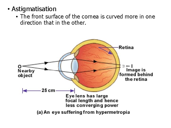  • Astigmatisation • The front surface of the cornea is curved more in