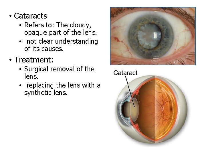  • Cataracts • Refers to: The cloudy, opaque part of the lens. •