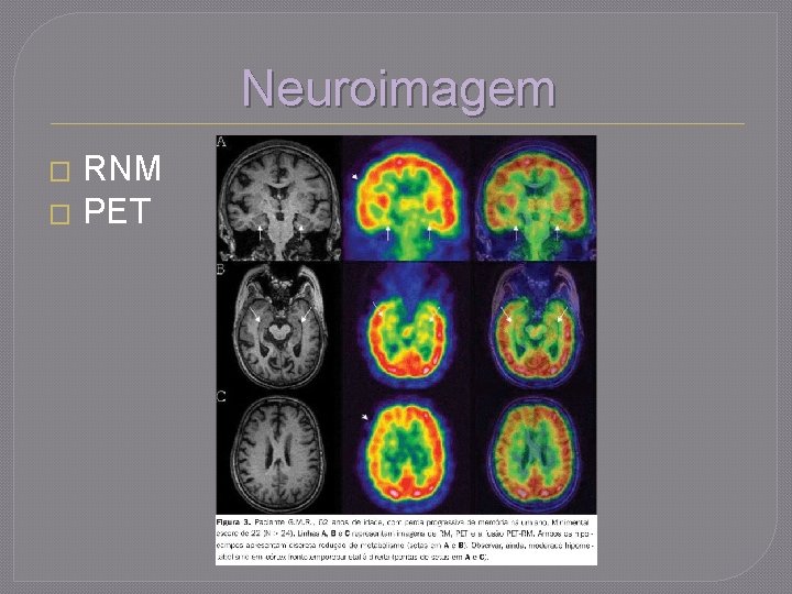 Neuroimagem RNM � PET � 