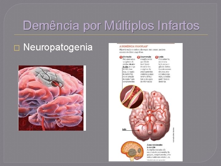 Demência por Múltiplos Infartos � Neuropatogenia 