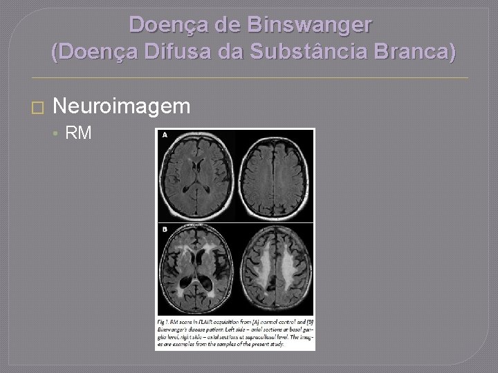 Doença de Binswanger (Doença Difusa da Substância Branca) � Neuroimagem • RM 