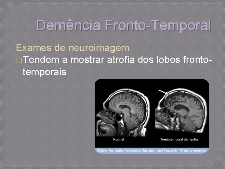 Demência Fronto-Temporal Exames de neuroimagem �Tendem a mostrar atrofia dos lobos frontotemporais 