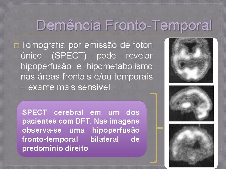 Demência Fronto-Temporal � Tomografia por emissão de fóton único (SPECT) pode revelar hipoperfusão e