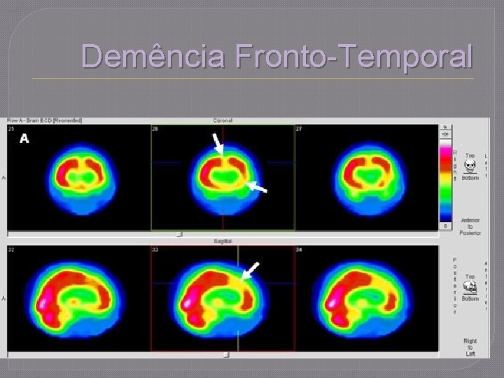 Demência Fronto-Temporal 