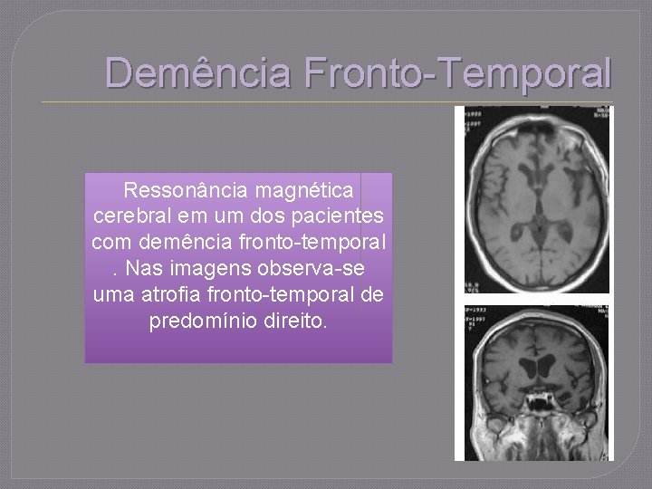 Demência Fronto-Temporal Ressonância magnética cerebral em um dos pacientes com demência fronto-temporal. Nas imagens