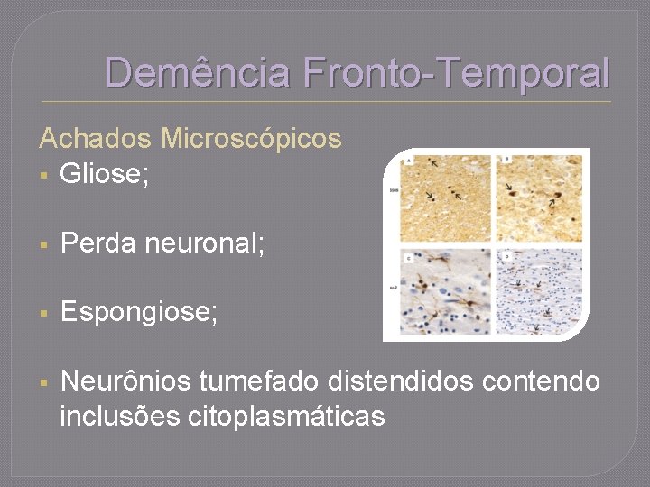 Demência Fronto-Temporal Achados Microscópicos § Gliose; § Perda neuronal; § Espongiose; § Neurônios tumefado