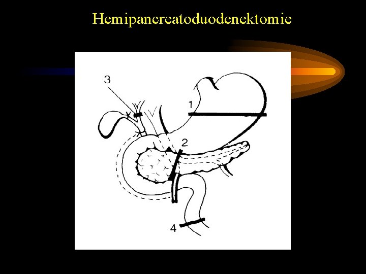 Hemipancreatoduodenektomie 