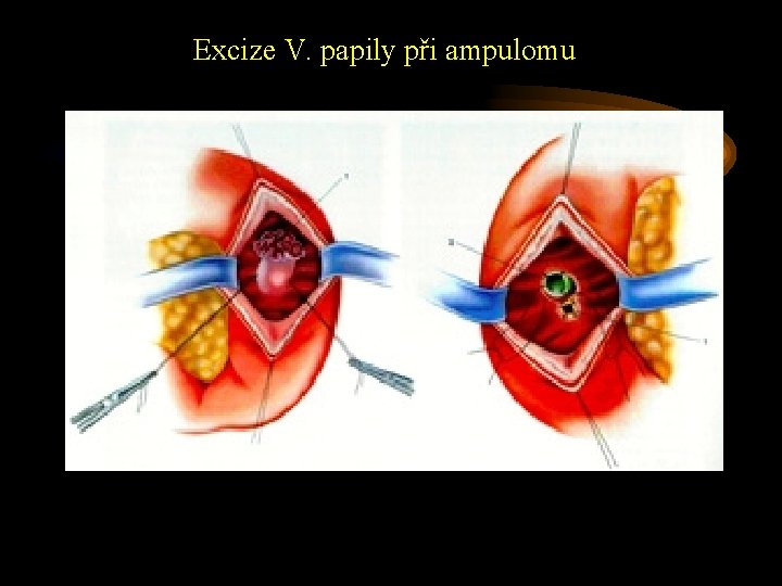 Excize V. papily při ampulomu 