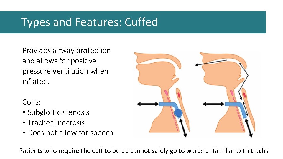Types and Features: Cuffed Provides airway protection and allows for positive pressure ventilation when Types and Features: Cuffed Provides airway protection and allows for positive pressure ventilation when