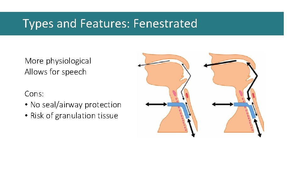 Types and Features: Fenestrated More physiological Allows for speech Cons: • No seal/airway protection Types and Features: Fenestrated More physiological Allows for speech Cons: • No seal/airway protection