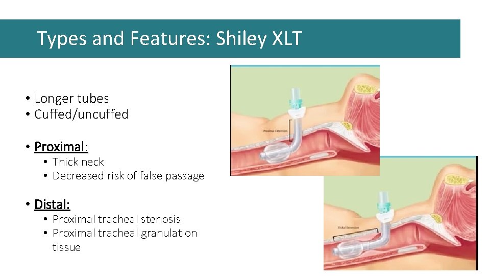 Types and Features: Shiley XLT • Longer tubes • Cuffed/uncuffed • Proximal: • Thick Types and Features: Shiley XLT • Longer tubes • Cuffed/uncuffed • Proximal: • Thick